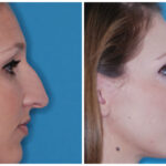 Medical Reasons for Getting a Nose Job