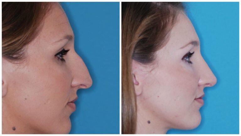 Medical Reasons for Getting a Nose Job